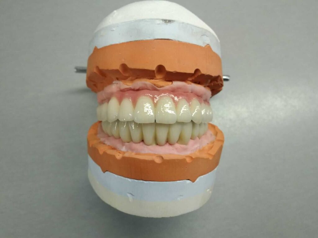 קוסטרוקציה השתלת שיניים